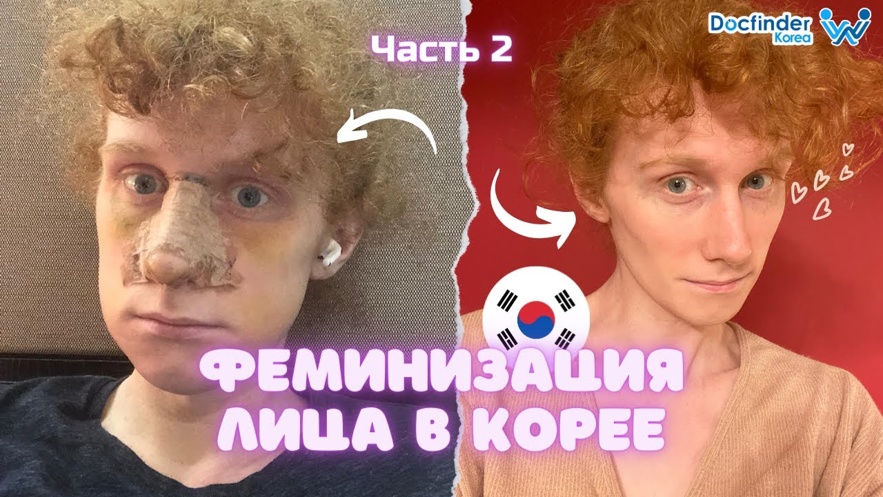 Феминизация лица в Корее. Пластическая операция. Часть 2/ Лея в Корее.