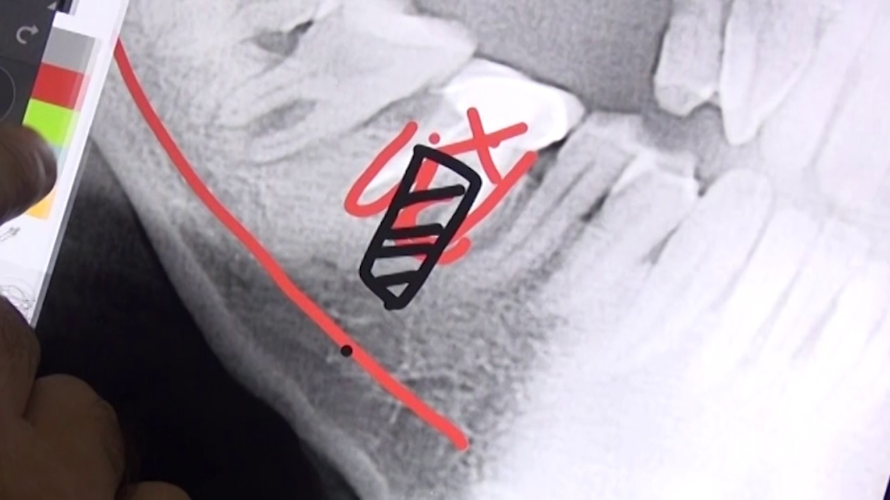 Immediate dental implant after extracting infected tooth - Dr German Arzate DDS