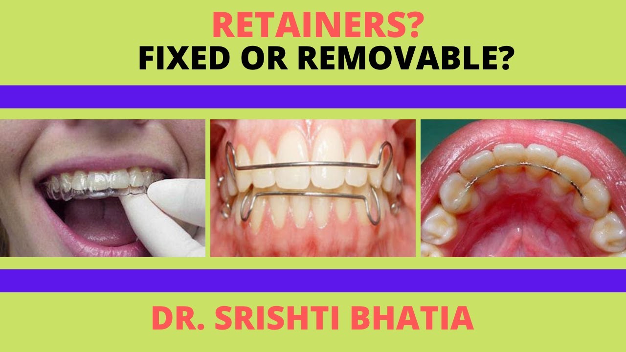 Fixed or Removable RETAINERS after braces? कौन सा RETAINER चुनें ब्रेसेस के बाद?-Dr.Srishti Bhatia