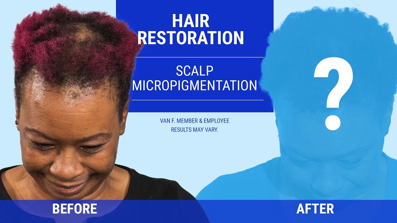 Scalp Micropigmentation | SMP |  Less Time on Hair Loss, More Living Life!