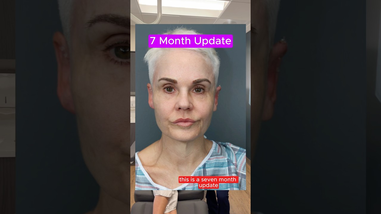 Facelift 7 Month Update (Interview)