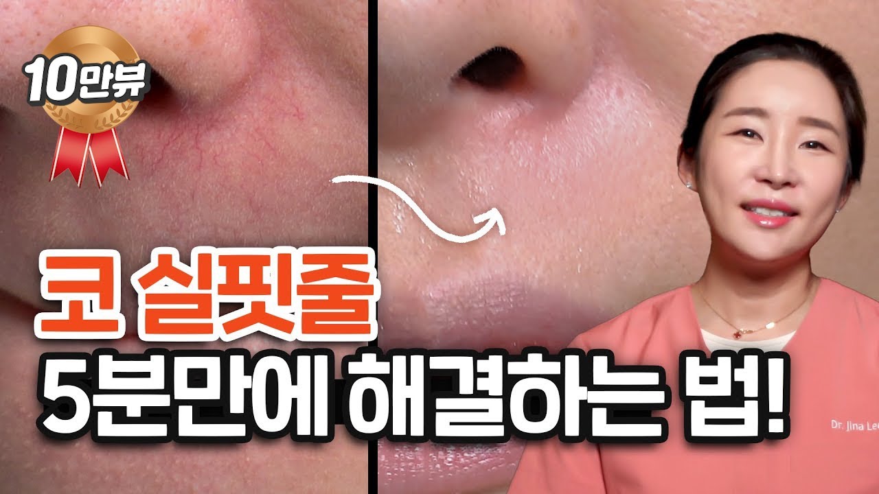코 실핏줄 | 코 모세혈관 확장증 5분 만에 없애는 법!!! | 얼굴 실핏줄과 안면홍조가 고민이라면?! PD도 궁금해서 받은 그 시술!!
