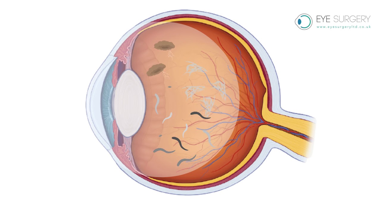 Floaters and Posterior Vitreous Detachment (PVD)