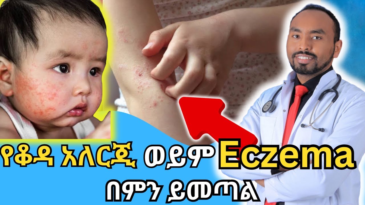 የቆዳ አለርጂ ወይም Eczema በምን ይመጣል | What causes skin allergy or eczema | Dr. Fasil