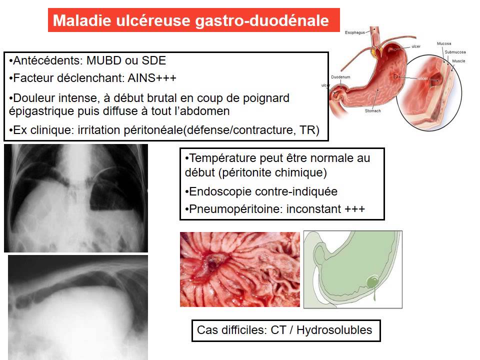 GASTRO-ENTEROLOGIE douleur epigastrique aigue