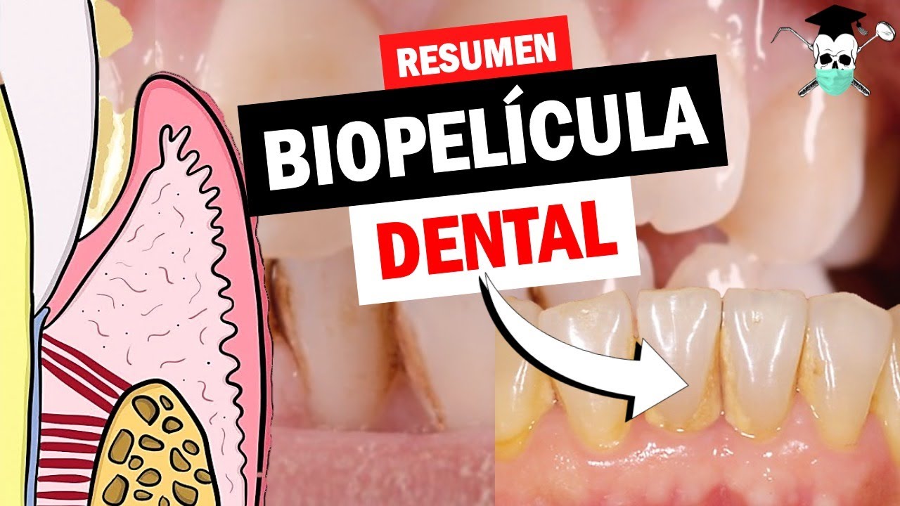 ¿Qué es la PLACA DENTAL, BIOFILM o BIOPELICULA?  *Pirámide de Socransky*