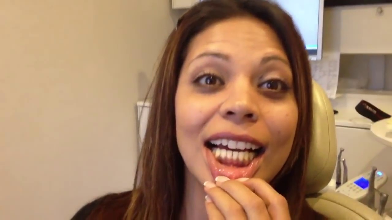 Gingival Pigmentation Removal (Dark Gums) | Gummy Smile Review