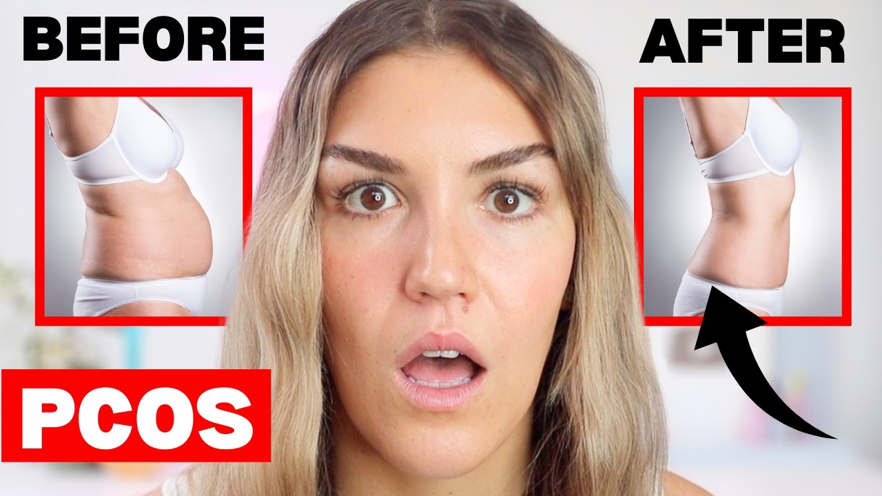 What Causes PCOS and How to Reverse It (For Good!)