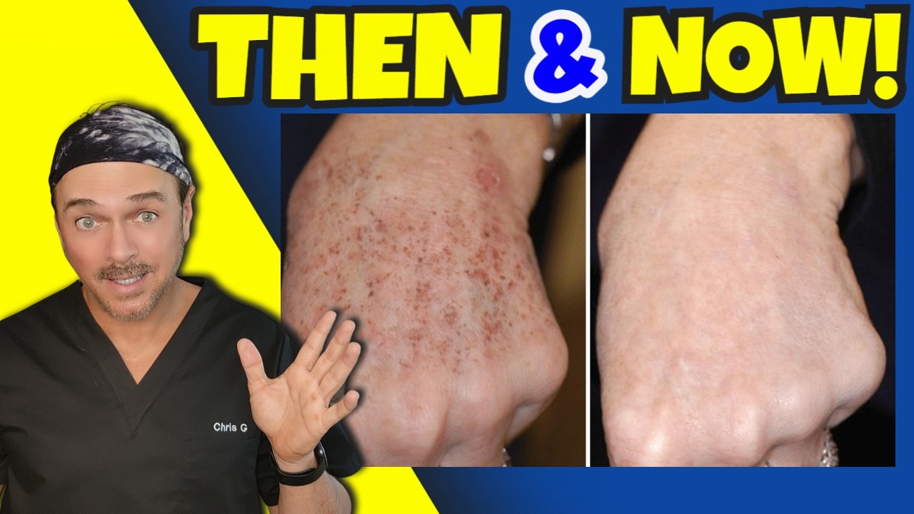 Erasing Years Of Skin Damage Anywhere In Minutes!