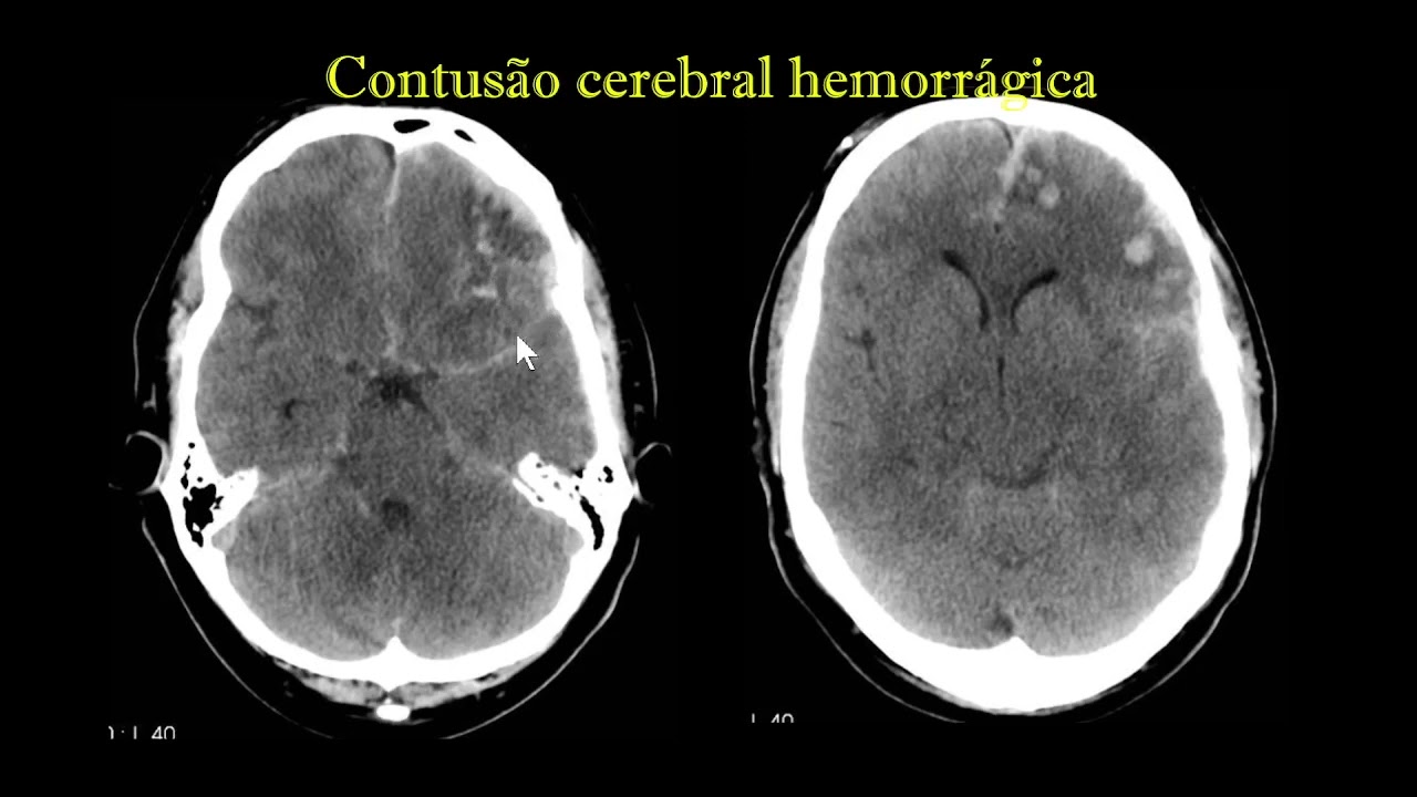 Contusão cerebral hemorrágica