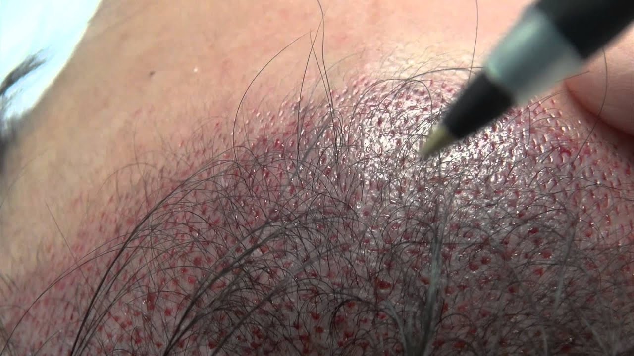Asian Hairline Design Principles (Macro & Micro Hairline)