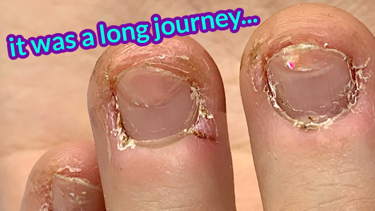 Bitten Nails Transformation - 2 years later! Anna's Last fill 😢