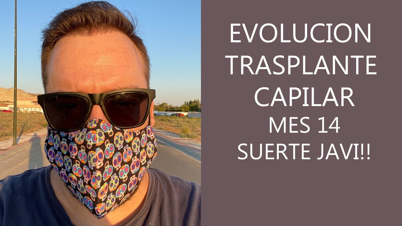 Evolución Trasplante capilar en Turquía - 14 meses