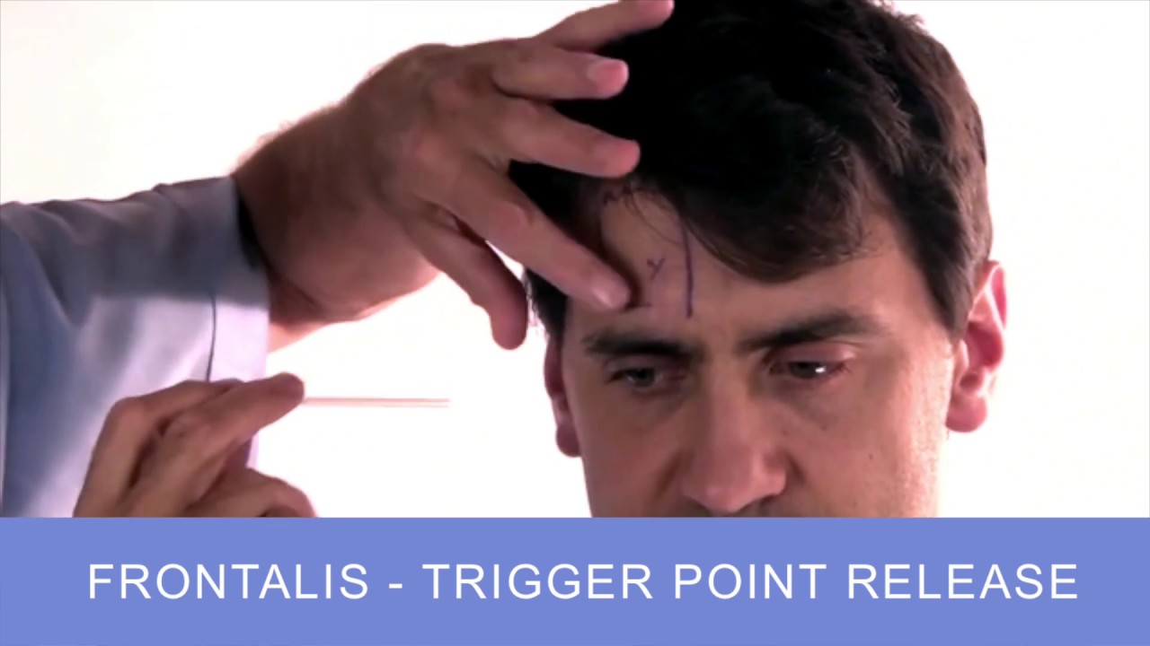 Dry Needling Medical Acupuncture for Trigger Point Release - Frontalis Muscle