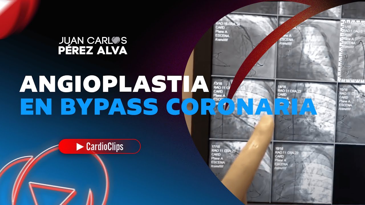 ANGIOPLASTIA EN BYPASS CORONARIO / Dr Pérez Alva