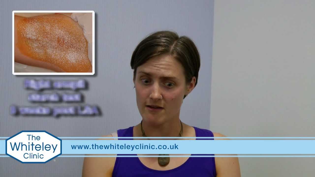 Laser Sweat Ablation cured under arm-sweating (LSA)