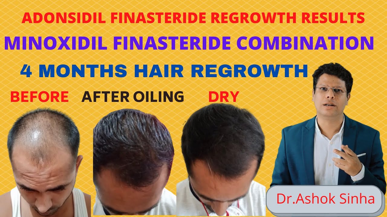 Best Hair Regrowth Treatment For Men