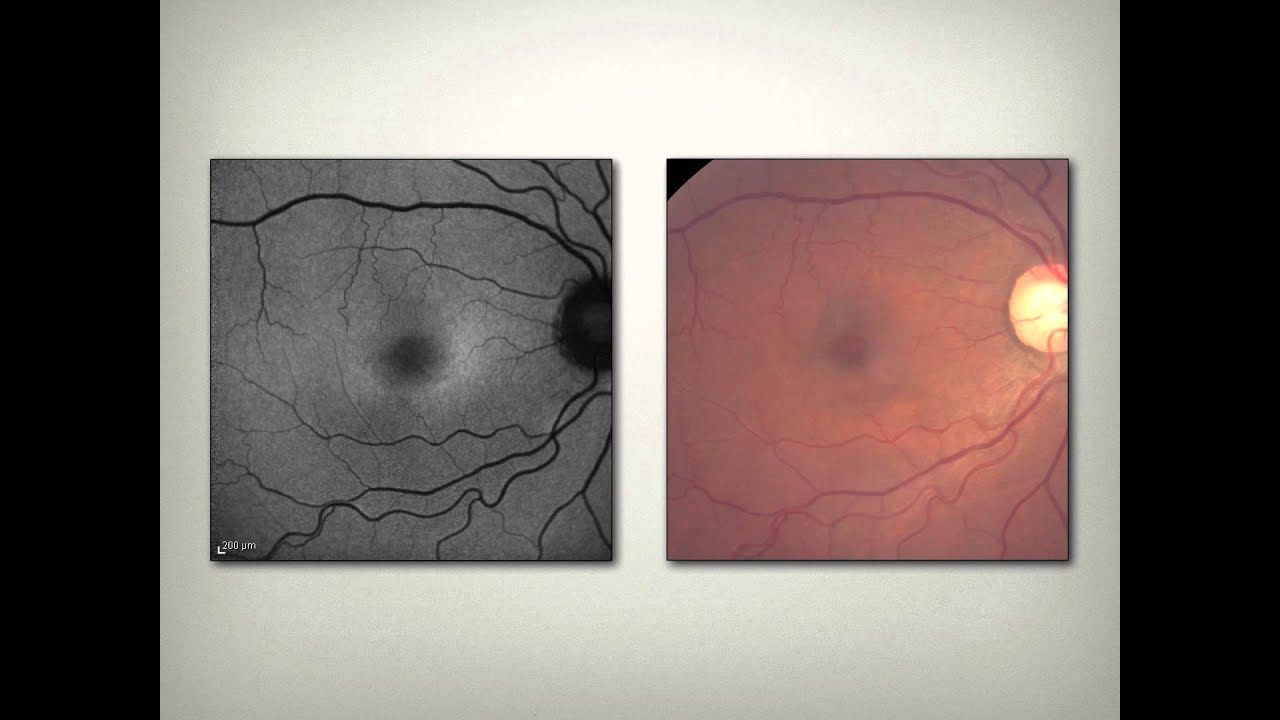 Retina and Systemic Disease Part 3