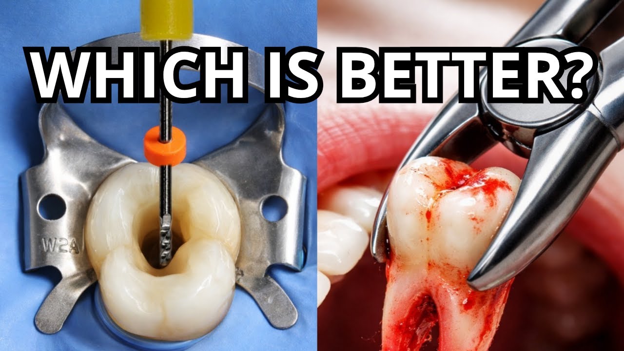 Root Canal or Extraction? The Wrong Choice Can Cost You