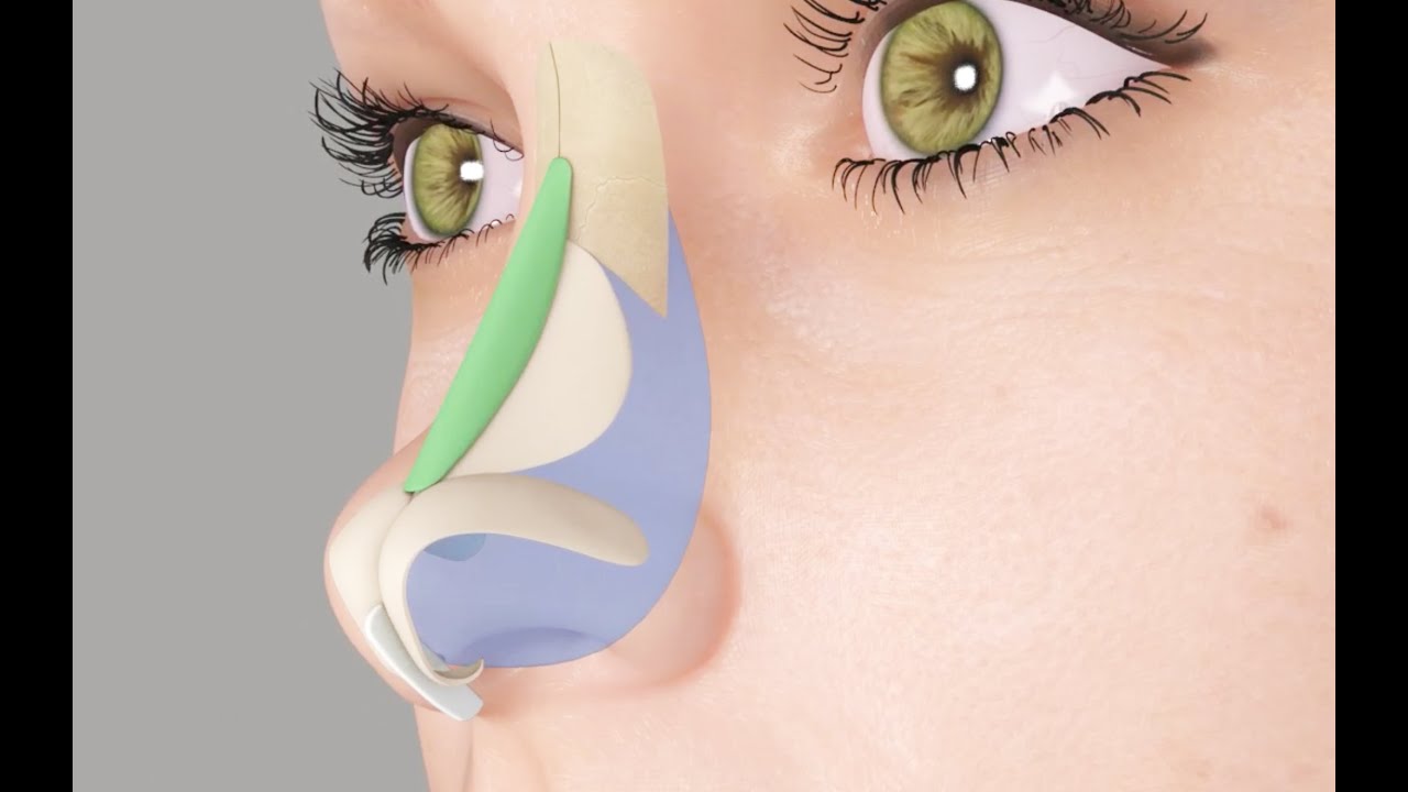 Седло Нос или Лыжный склон Нос Ринопластика Nosejob