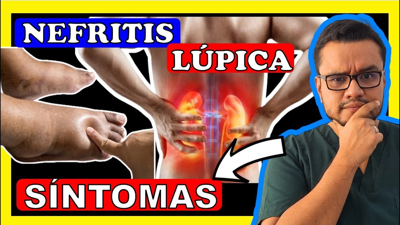❌ NEFRITIS LUPICA: Asi es como el LUPUS afecta a los RIÑONES