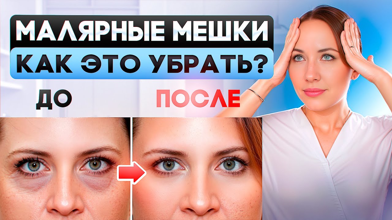 Как убрать малярные мешки?