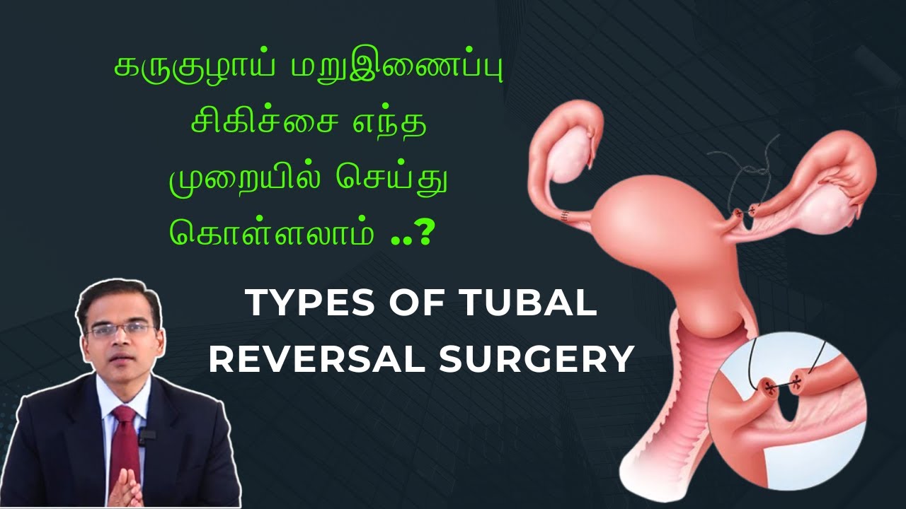 கருகுழாய் மறுஇணைப்பு சிகிச்சை எந்த முறையில் செய்து கொள்ளலாம் ..? Types Of Tubal Reversal Surgery