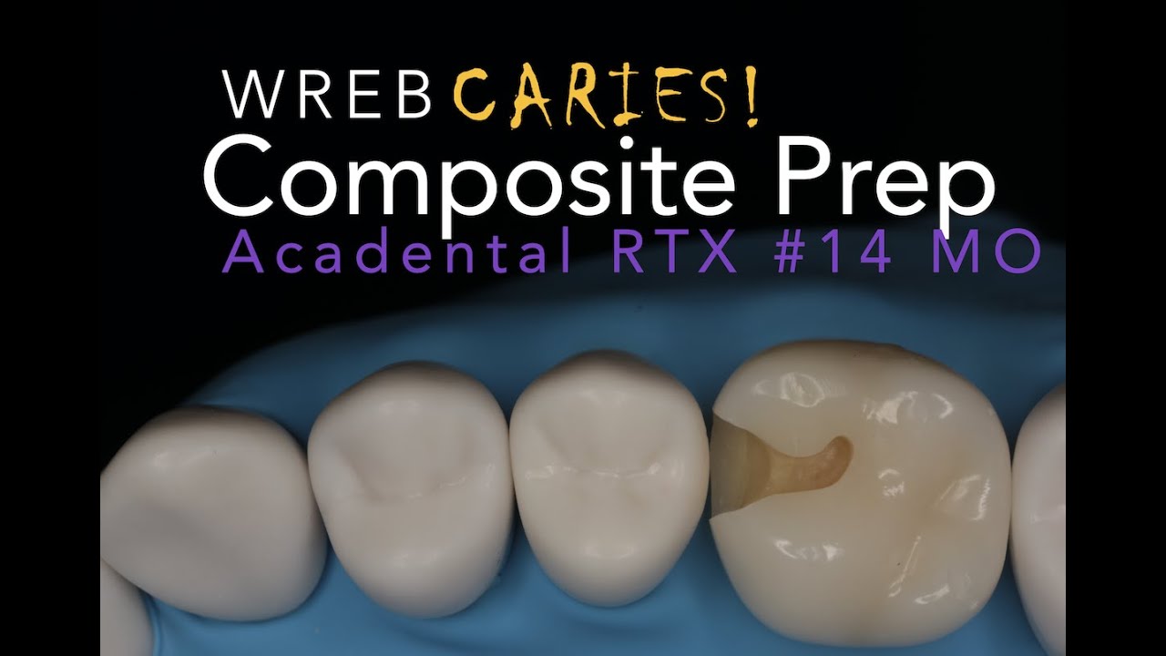 Class II #14 MO Preparation RTX Caries Tooth for WREB