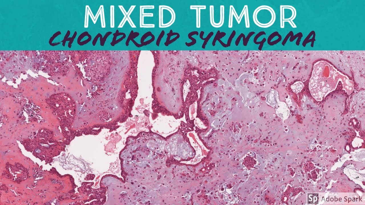 Chondroid Syringoma (Mixed Tumor): 5-Minute Pathology Pearls