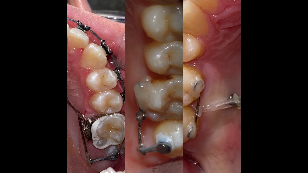 3 Maneiras de corrigir Molar em Brodie !!!