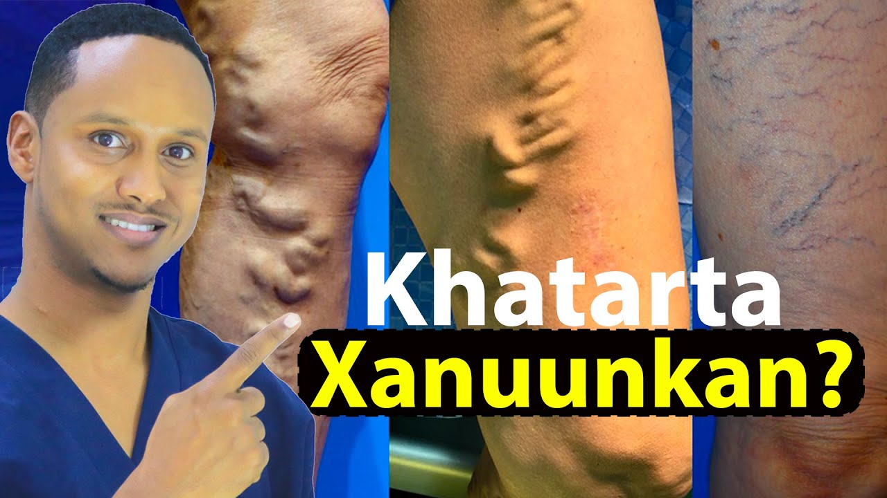 Halista ka iman karta xididada noocan ah!