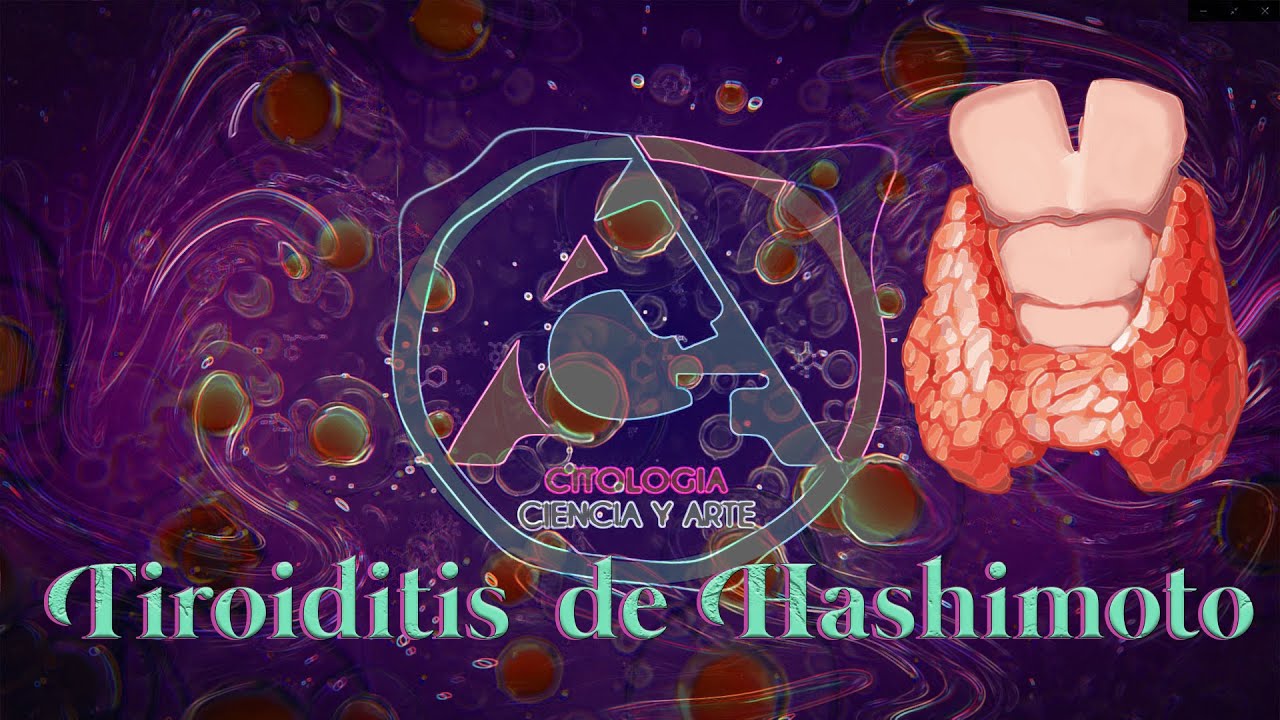 Tiroiditis de Hashimoto