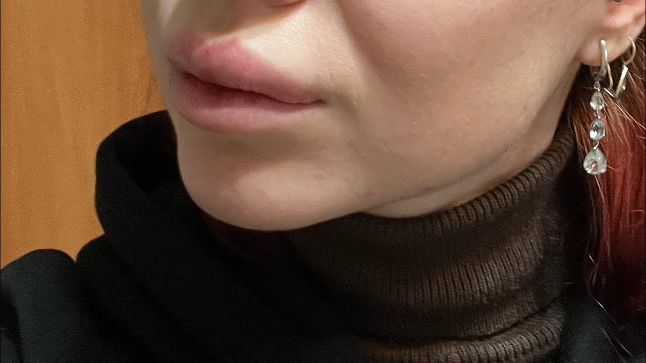 УДАЛИЛА ГУБЫ😱 Больно? Страшно? Дорого?