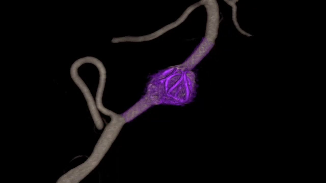 Dissecting Aneurysm Vertebral Artery - Acute Flow Diverter