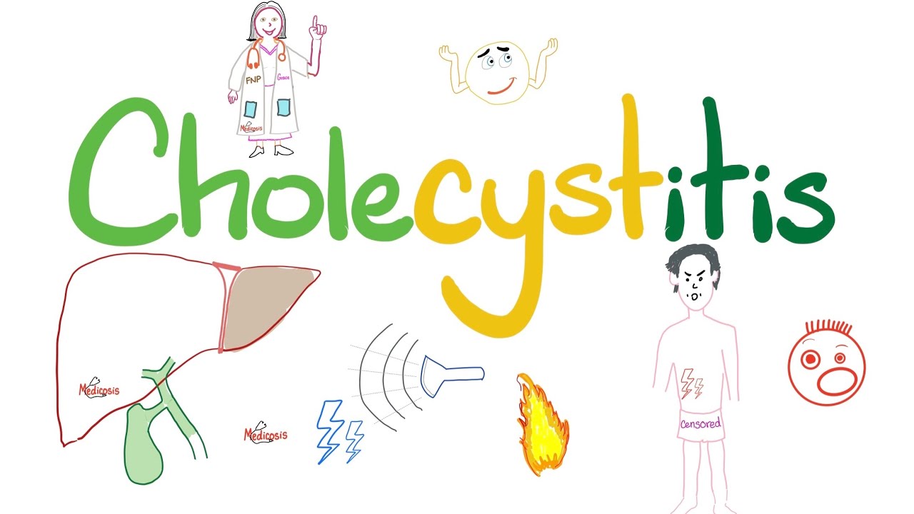Cholecystitis - A Tale of One Stone (Cholelith) - The most COMPREHENSIVE Review