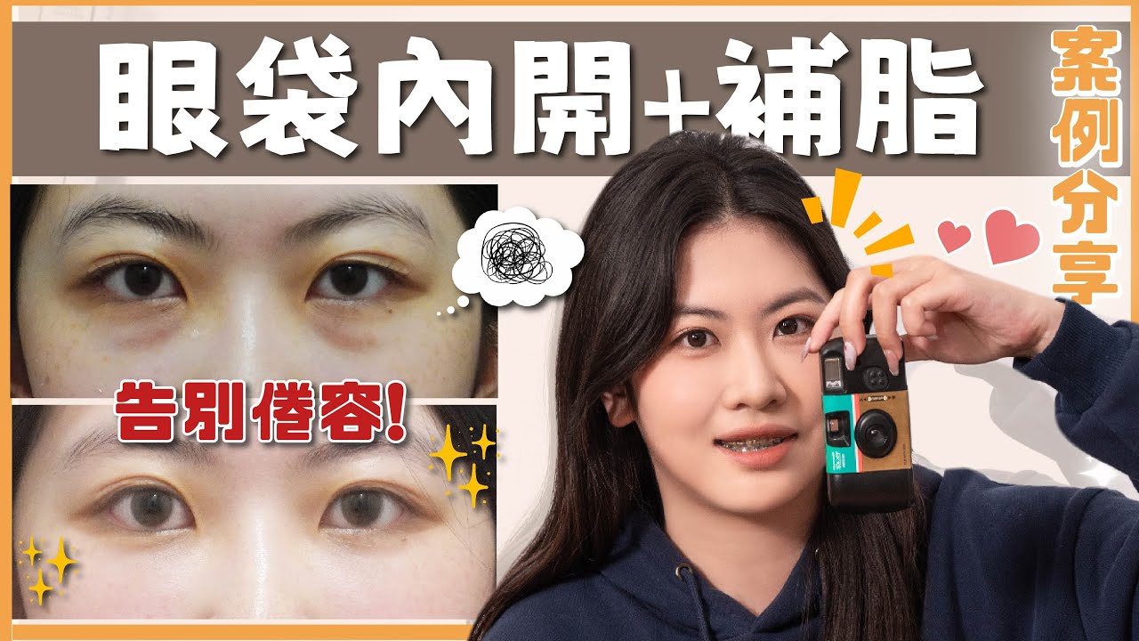 【#高雄眼袋｜真實見證】👁️還原明眸，內開眼袋讓青春擺脫疲態｜整形外科姚勝發醫師