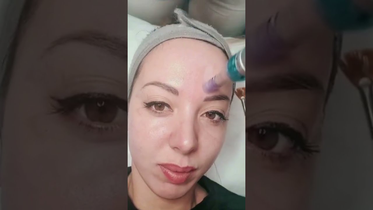 Dermapulse Pixel Peel