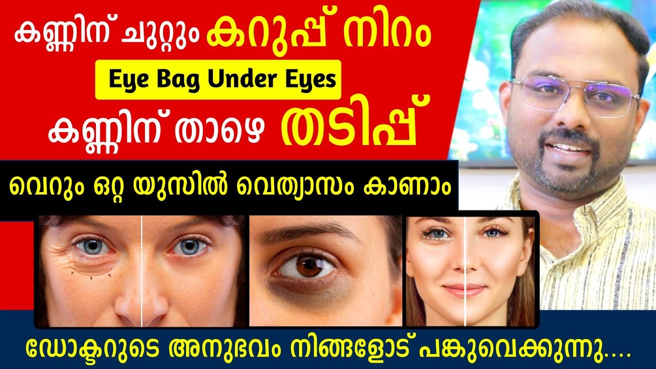 കണ്ണിന് ചുറ്റും ഉള്ള കറുപ്പും തടിപ്പും പൂർണമായി മാറാൻ എളുപ്പവഴി_ Remove under eye darkness & eye bag