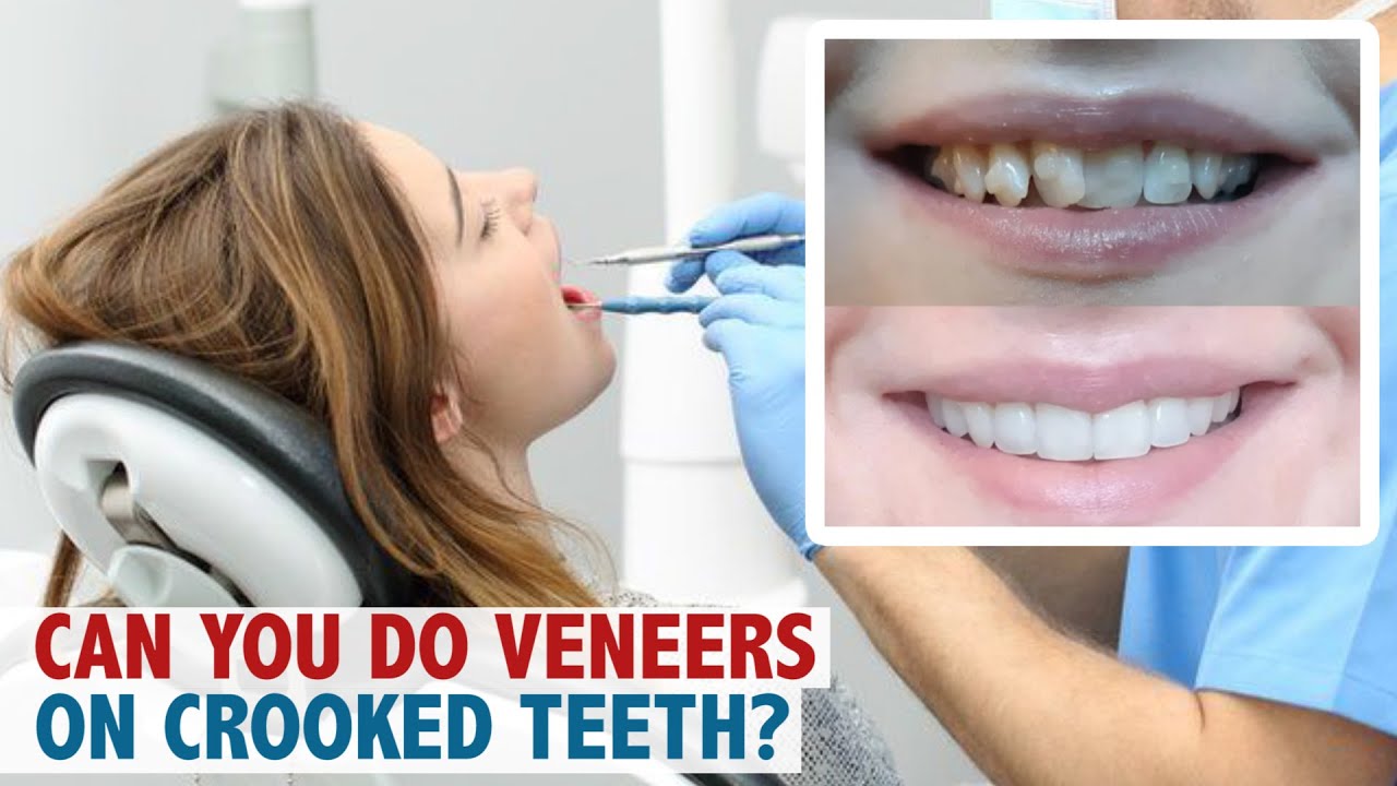 Can you do veneers on crooked teeth ?