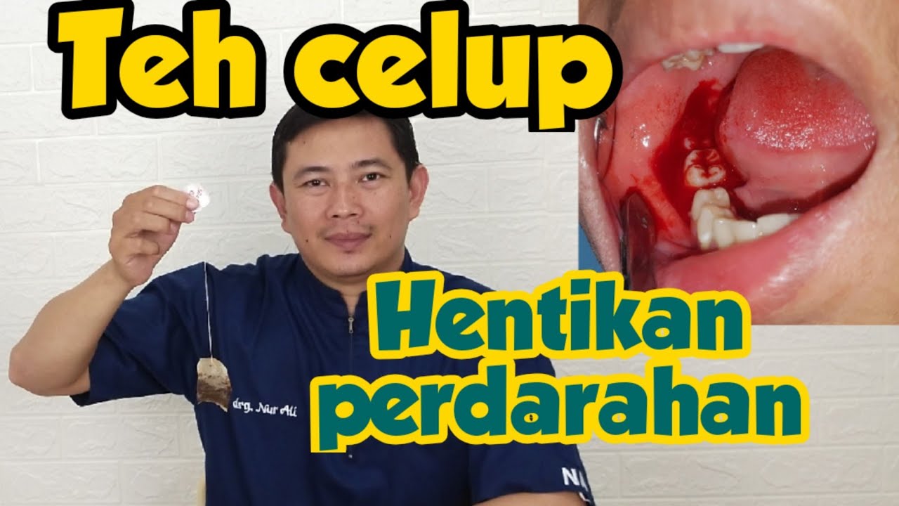 Cara menghentikan perdarahan setelah cabut gigi dengan teh celup