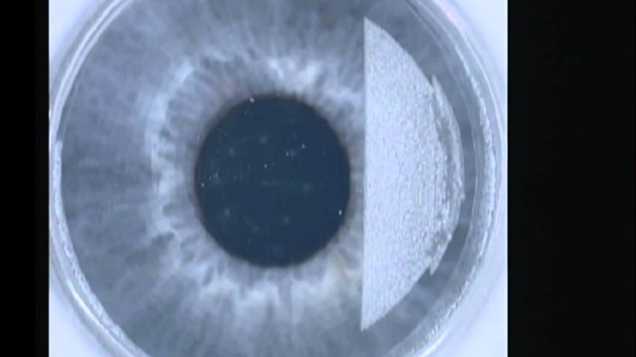 Intralase Lasik Flap Creation