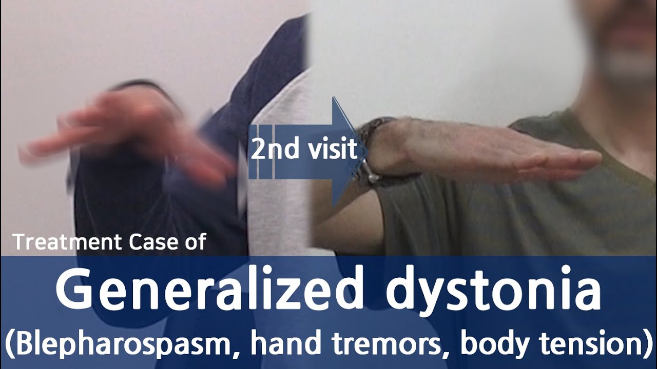 Generalized Dystonia / Cervical dystonia, Dysphonia, Oromandibular dystonia / 전신 디스토니아 치료사례 / 근긴장이상증