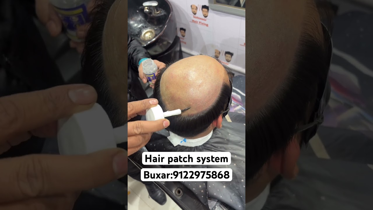 Hair patch system #hairwig #hairlosscure #wigs #hairlosstreatment #hairwig #hair #hairpatch #harlin