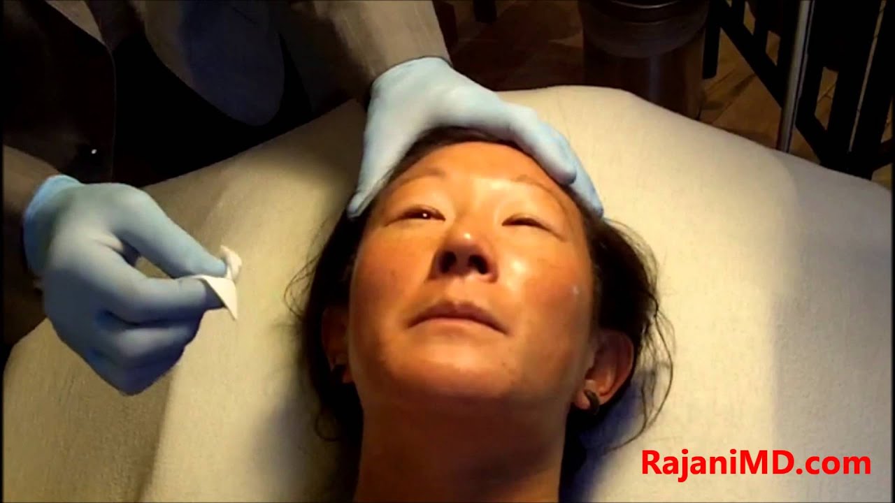 Chemical Peel-Brighten and Tighten skin -Dr Rajani Portland