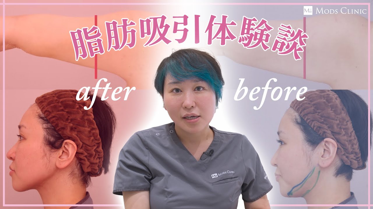脂肪吸引体験記 -顔・二の腕 編-／立山彩子 医師｜Mods Clinic（モッズクリニック）
