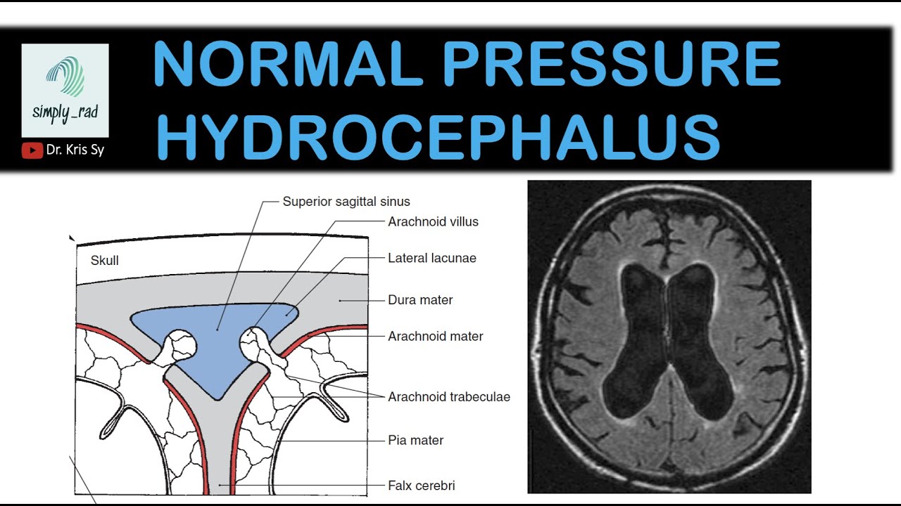 Normal pressure hydrocephalus