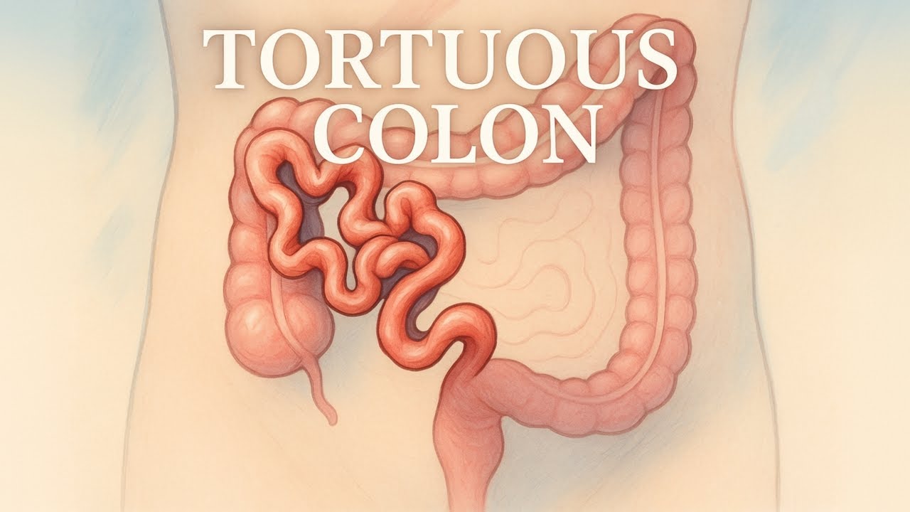 GI Focus: Tortuous Colon @drlizcruz