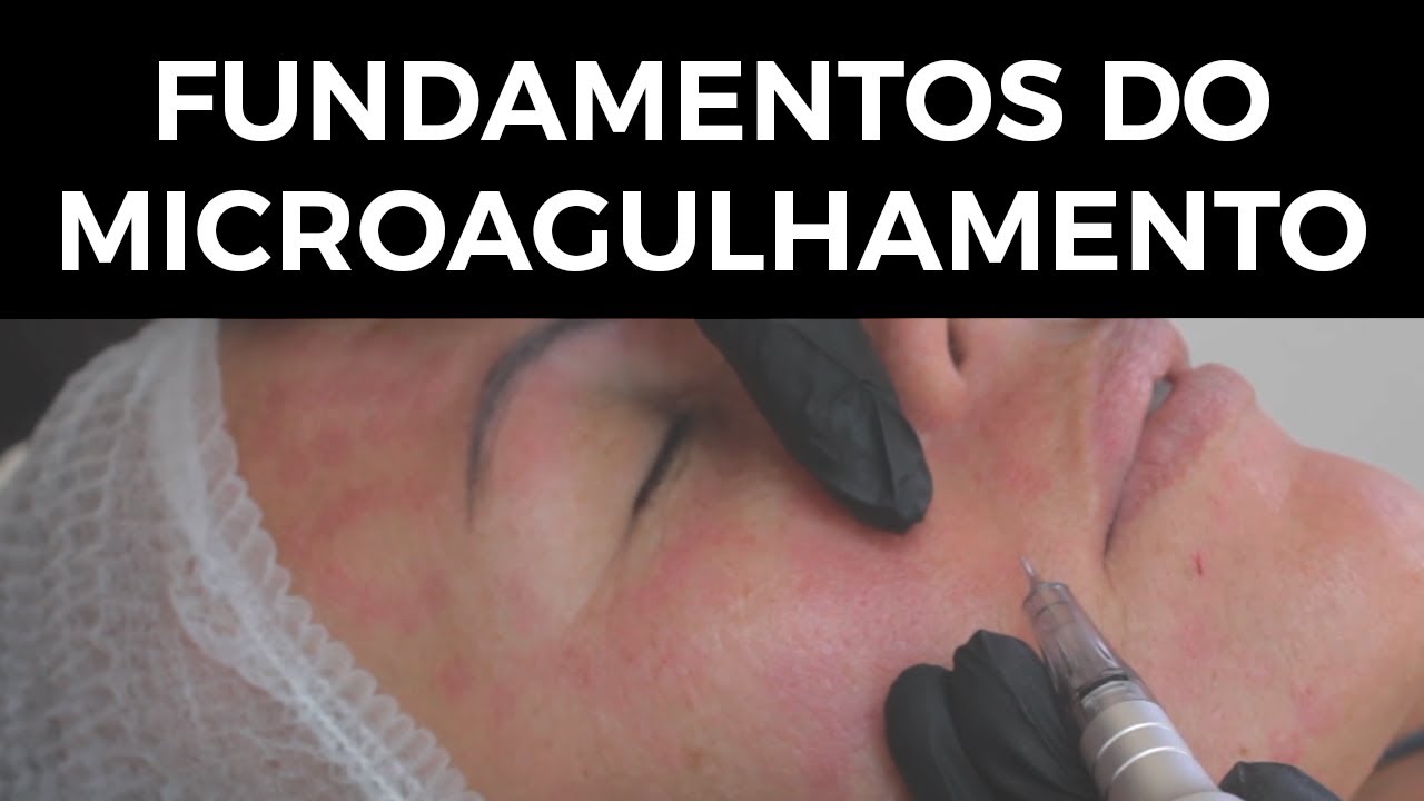 FUNDAMENTOS DO MICROAGULHAMENTO