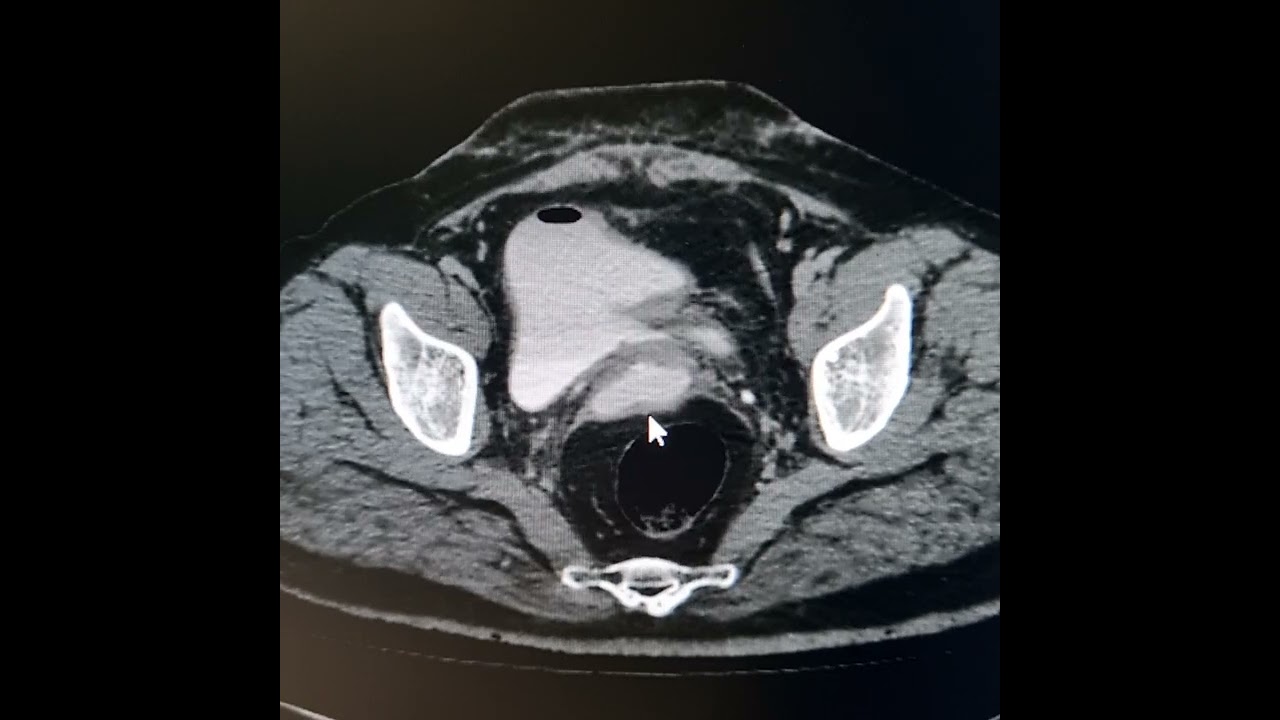 Vesicovaginal fistula.