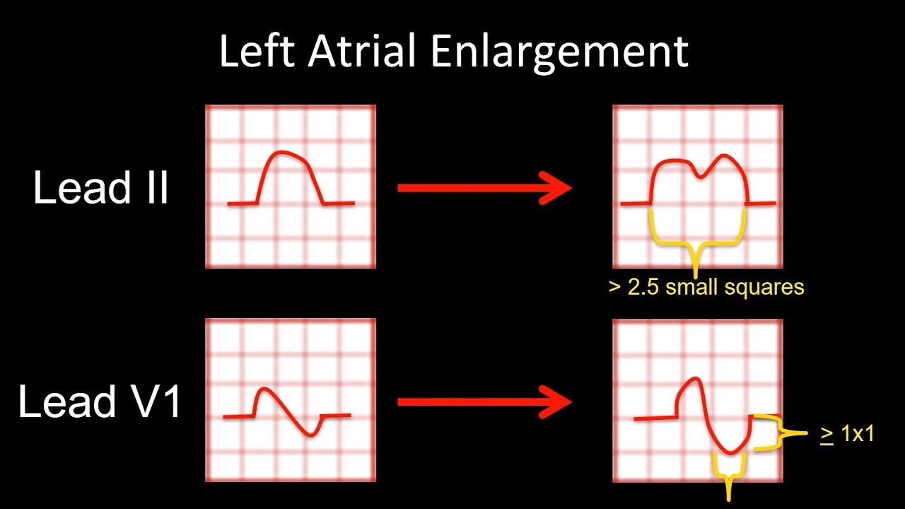 How to Read an ECG: Examining the P wave, right and left atrial enlargement, atrial hypertrophy.